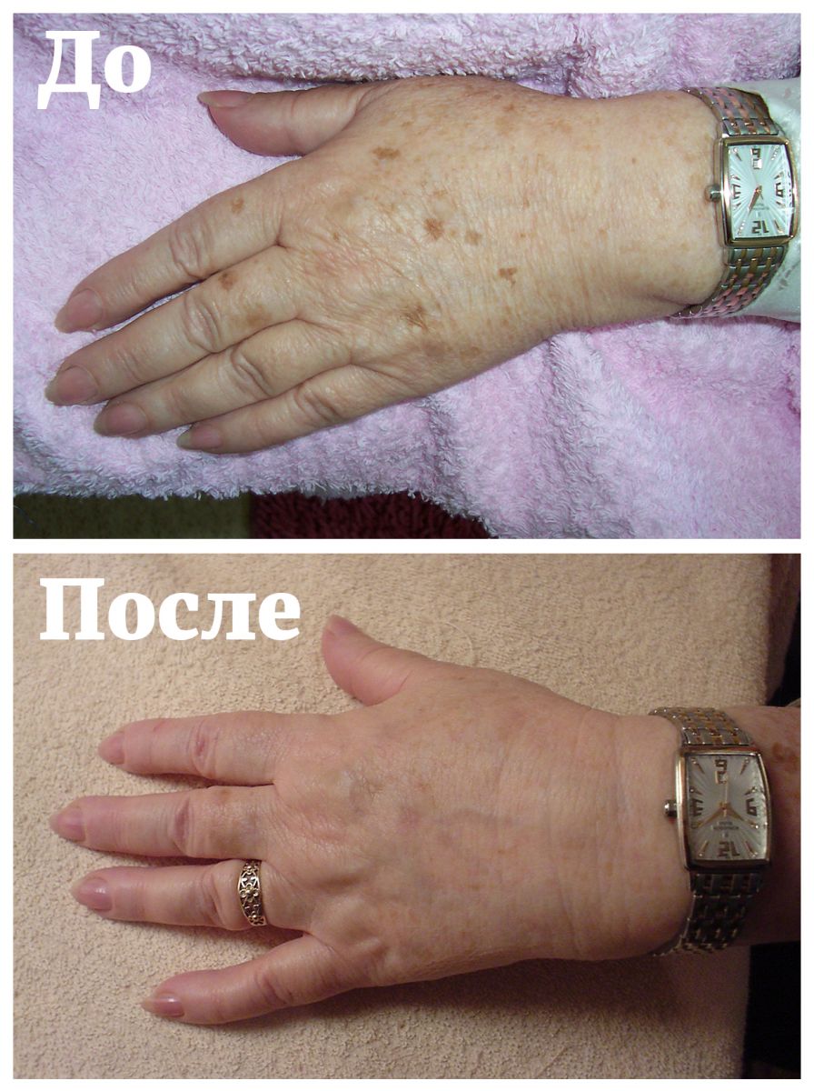 Лечение пигментации кожи лазером в Алматы