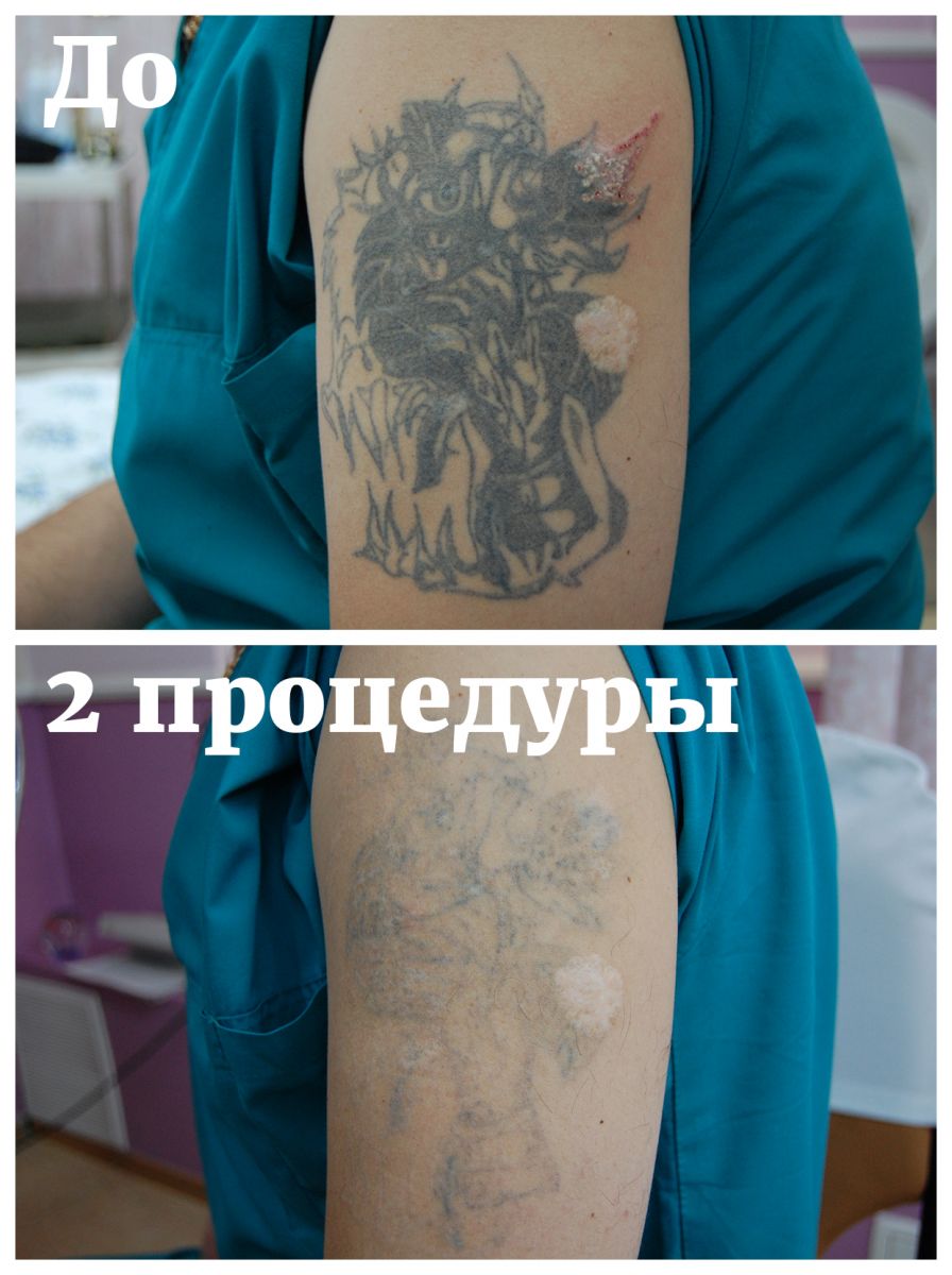 Удаление татуировки лазером в Алматы
