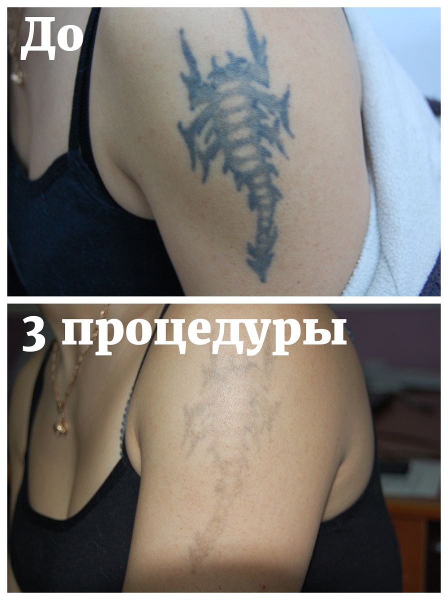 Удаление татуировки лазером в Алматы